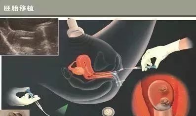 怀代生包成功借卵生子生殖医学中心
